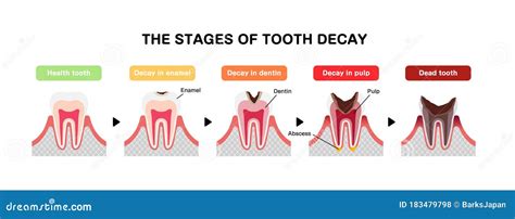 The Stages of Tooth Decay / Flat Vector Illustration Stock Vector ...