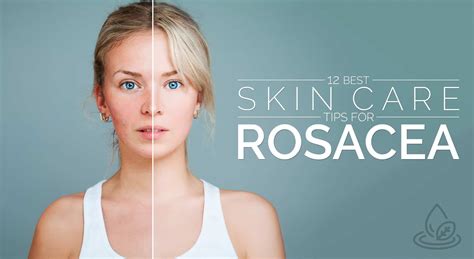 12 Best Skin Care Tips For Rosacea – Positive Health Wellness