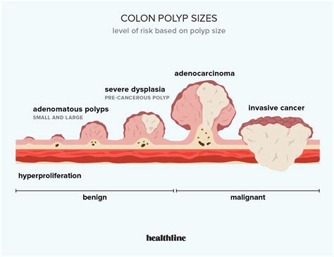 Sessile Serrated Polyps Cancer Risk And Appropriate