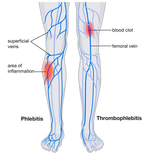 Describe Blood Clot Pain in Leg - GilbertokruwHale