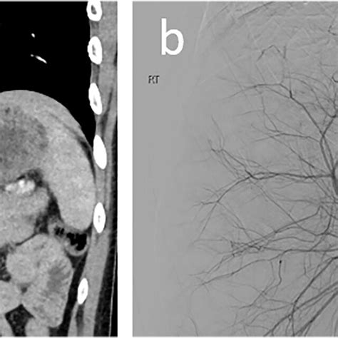 AAST grade III liver laceration (a) in segment 7 with possible... | Download Scientific Diagram