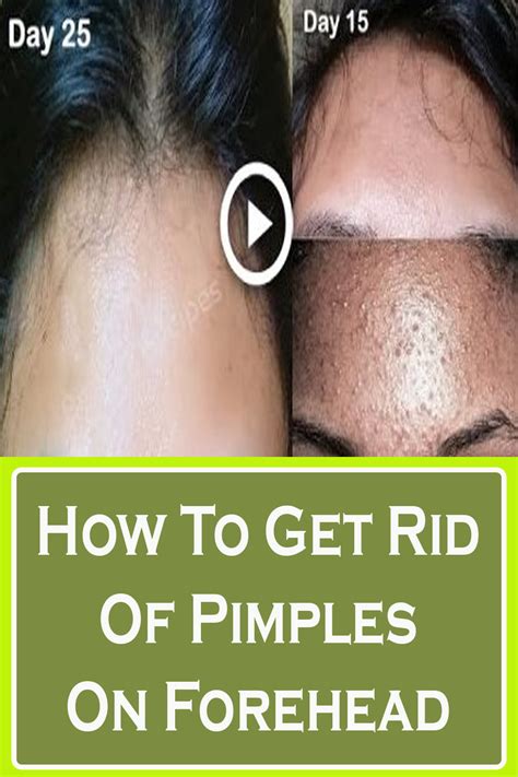 How To Get Rid Of Pimples On Forehead - thepopularrecipe3