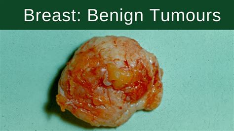 Benign Tumor Definition Of Benign Tumor By Medical