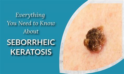 Flesh Colored Seborrheic Keratosis - Infoupdate Wallpaper Images