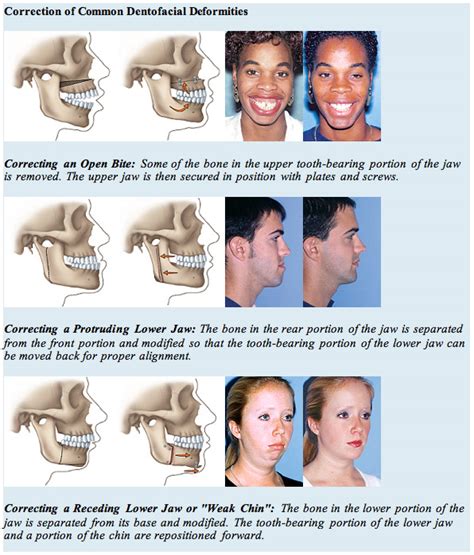 Orthognathic Surgery | Clark & Patel Oral Surgery