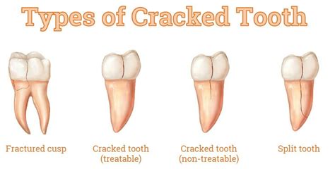 Chipped Tooth Repair Molar