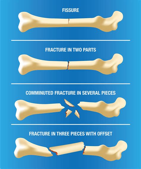 Complete Fracture Diagram