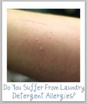 Laundry Detergent Allergy Symptoms And The Cure