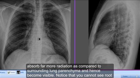 Right Lateral Chest Wall