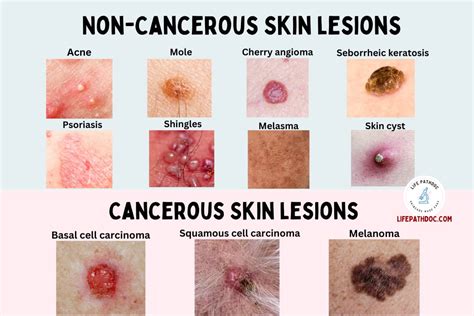 Types Of Skin Lesions Diagnosis Causes Symptoms And Treatment | Porn Sex Picture