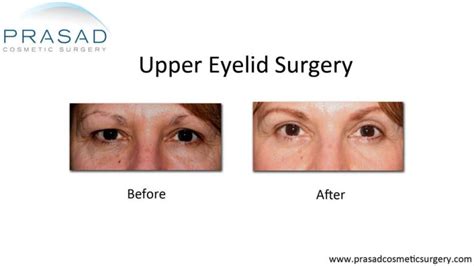 How Hooded Eye Surgery Scars are Minimized | Dr. Prasad Blog