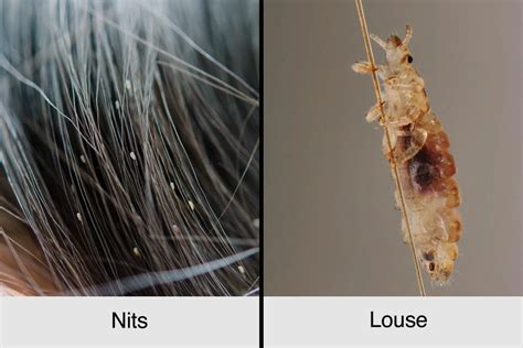 A Guide to Head Lice: Symptoms, Treatments, Prevention | The Healthy