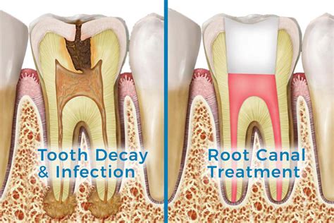 Root Canals | Extractions | Fillings | Parma OH 44134