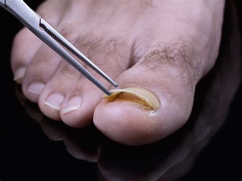 Toenail Fungus Pictures, Toenail Fungus Pictures Of What It Looks Like Treatment Tips, The ...