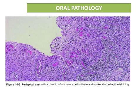 Radicular cyst or Periapical cyst