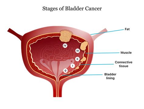 Comprehensive Bladder Cancer Guide: Symptoms, Treatments, and Risks