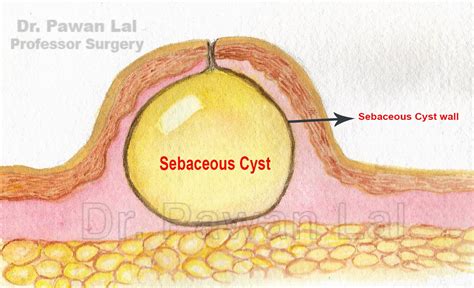 How To Get Rid Of Sebaceous Cysts On Scrotum - Longfamily26