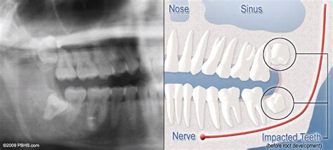 Wisdom Teeth Saint Marys GA | Third Molars | Impacted Tooth