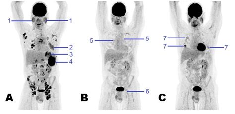 Pet Scan Images Of Lymphoma