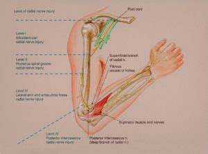 Radial Nerve Injury | Hand2Shoulder Clinic