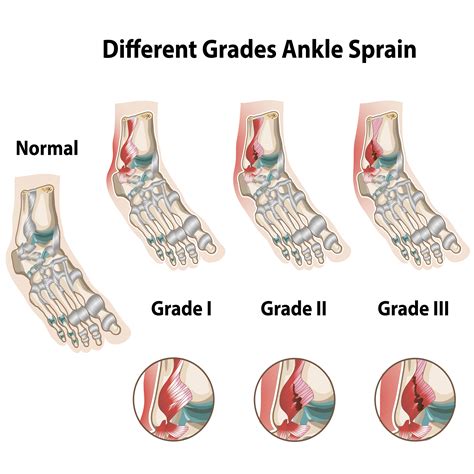 Laser Therapy for Ankle Sprain — Chiropractor Nashville, TN ...