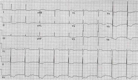 Hypokalemia Ecg Strip