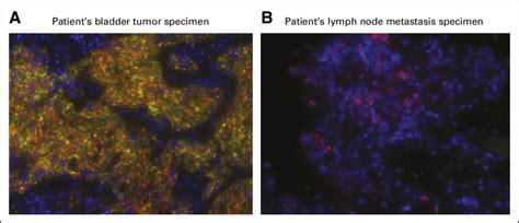 RNAScope multiplex fluorescent in situ hybridization. (A) Patient's... | Download Scientific Diagram