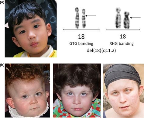 Chromosome Deletion Disorders