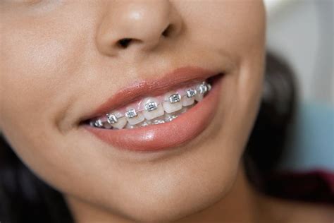 A Parent’s Handy Guide to the Different Types of Kids Braces - Pediatric Dentistry & Orthodontics