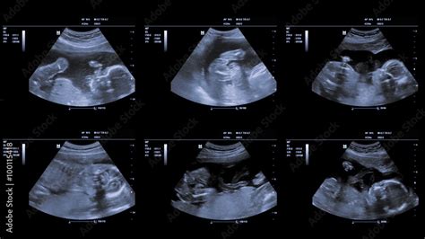 Ultrasound at 22 weeks. Stock Video | Adobe Stock