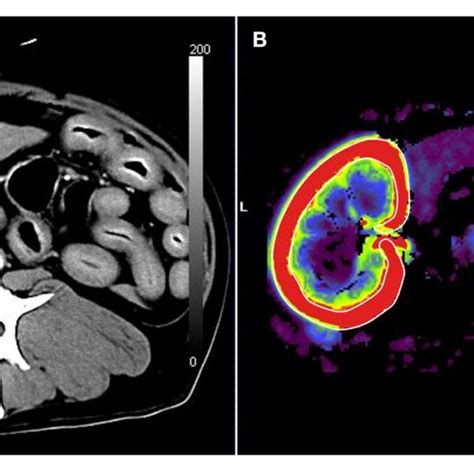 | Renal blood flow analysis using computed tomography perfusion images ...