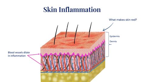 Skin Inflammation