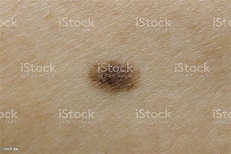 Junctional Nevus Found At Border Between Epidermis And Dermis Layers Of Skin Stock Photo ...