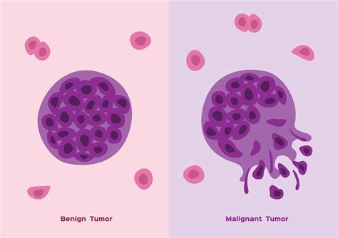 What are the differences between malignant and benign tumours?