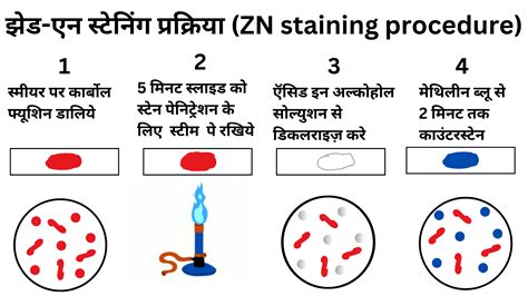 Stain (Ziehl-Neelsen Stain) Lab Tests Guide, 48% OFF