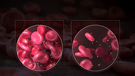 Different Types Of Anemia And What Causes Them