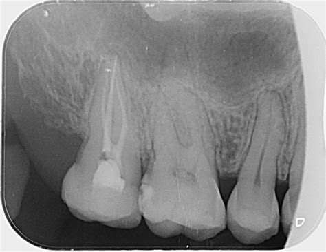 Periapical X-ray dental - Heritage Dental Group