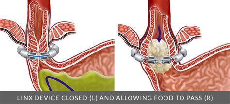 LINX Device for GORD Treatment in London, UK