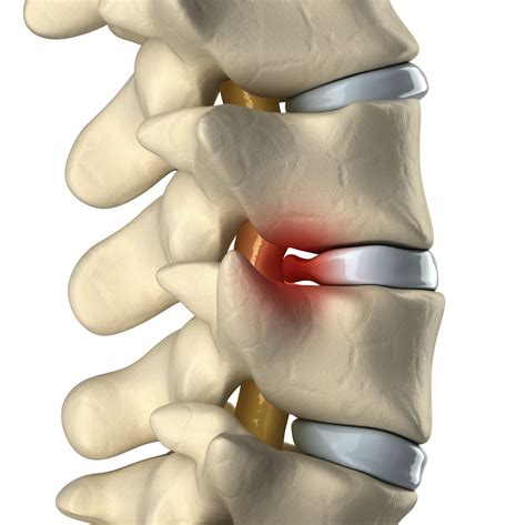 Little disc herniation - zikmerchant