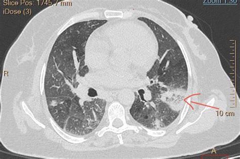 Atoll or reverse halo sign in Organizing Pneumonia . : r/Radiology