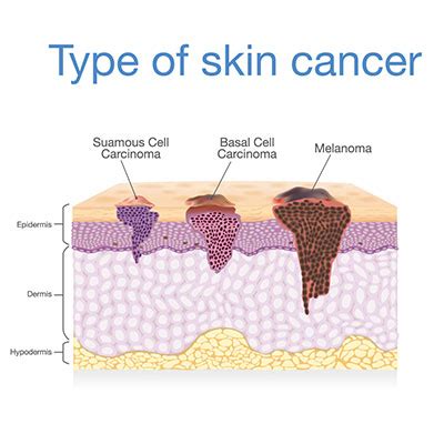 3 Warning Signs Skin Cancer For Early Detection | Vejthani