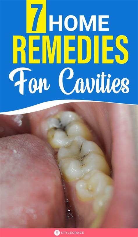 7 Home Remedies For Cavities | Natural cavity remedy, Home remedies for cavities, Cavity remedy