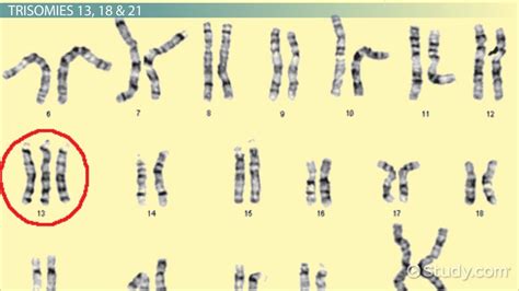 What Is Trisomy? - Definition & Symptoms - Lesson | Study.com