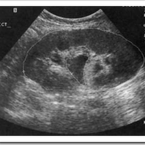 Ultrasound images Renal transplant dilatation - Radiology Imaging