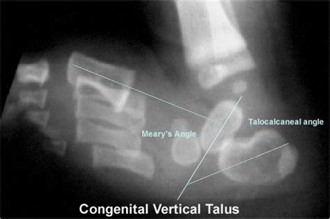 Calcaneovalgus Foot - Pediatrics - Orthobullets