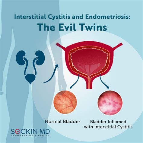 Interstitial Cystitis and Endometriosis: The Evil Twins