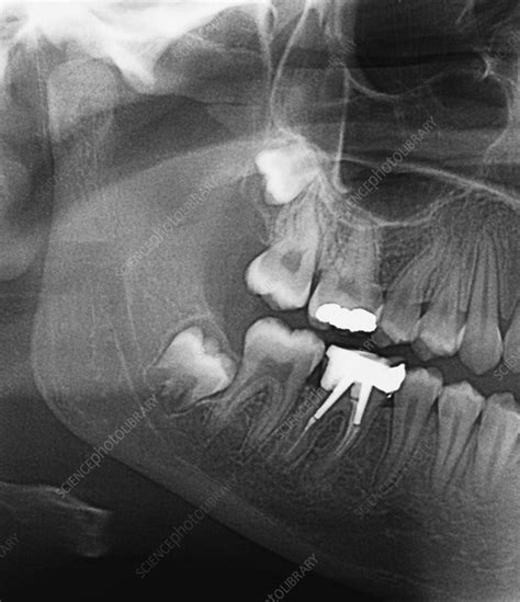 Impacted wisdom teeth, X-ray - Stock Image - M782/0249 - Science Photo ...