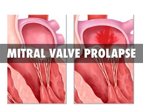 Confronting Mitral Valve Prolapse Syndrome Mitral Valve Repair | The ...