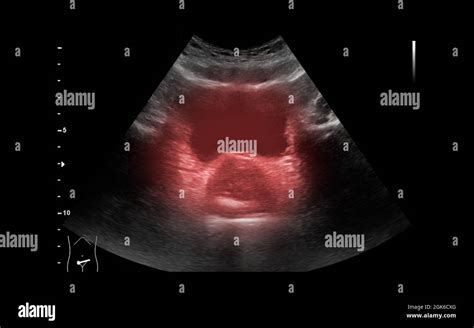 Ultrasound of urinary bladder or KUB for screening renal and bladder disease Stock Photo - Alamy