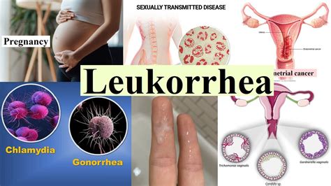 leukorrhea - YouTube